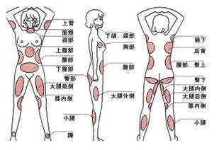 抽脂肪图片,抽脂术后的美丽蜕变之旅
